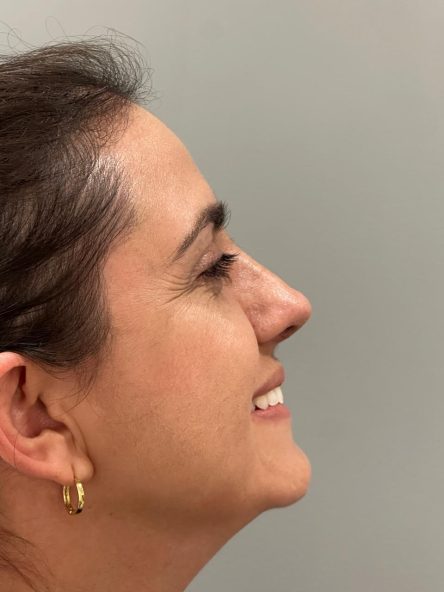 Rinoplastia · Depois