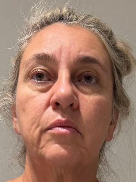 Blefaroplastia · Antes
