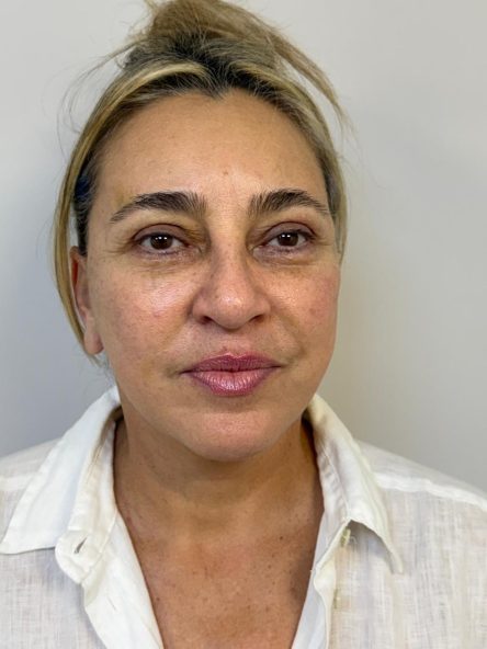 Blefaroplastia · Depois