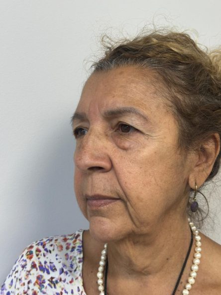 Brow Lift · Antes
