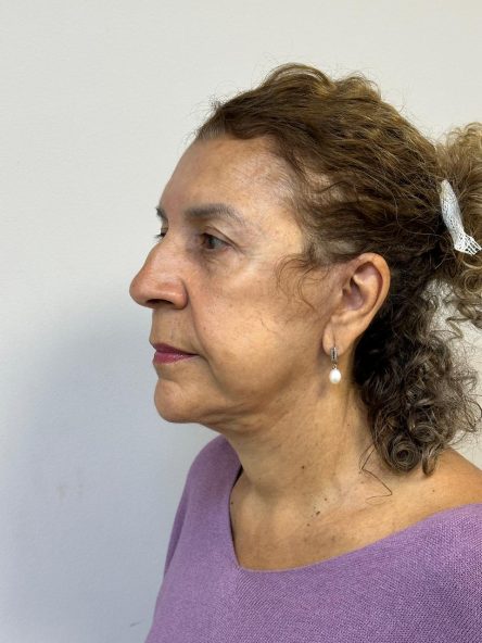 Resultado de brow lift - depois