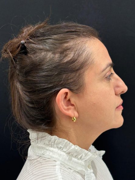 Rinoplastia · Antes